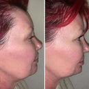 Masajeador Reductor y Rejuvenecedor Facial - RenovaSkin Pro